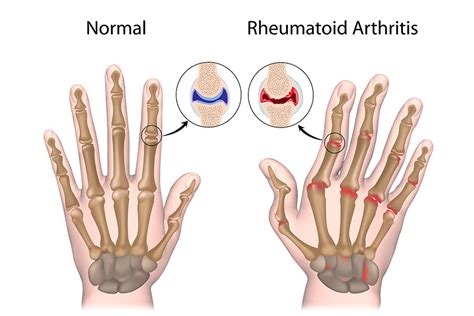 rheumatoid arthritis in seniors.